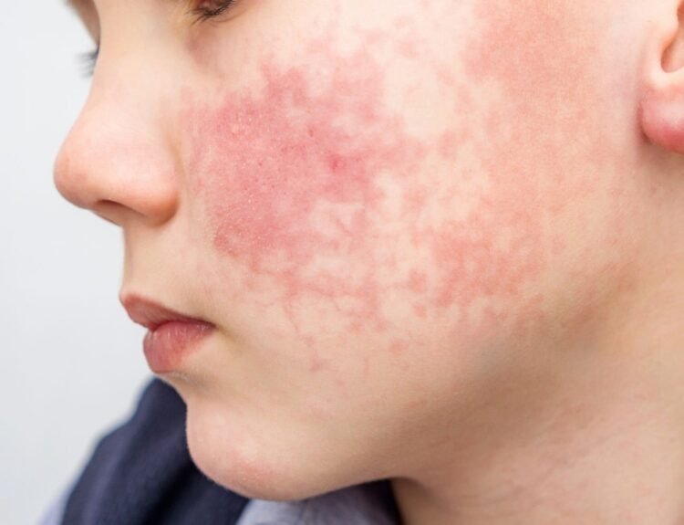 Why First Aid Beauty Is a Favorite for Redness and Irritation